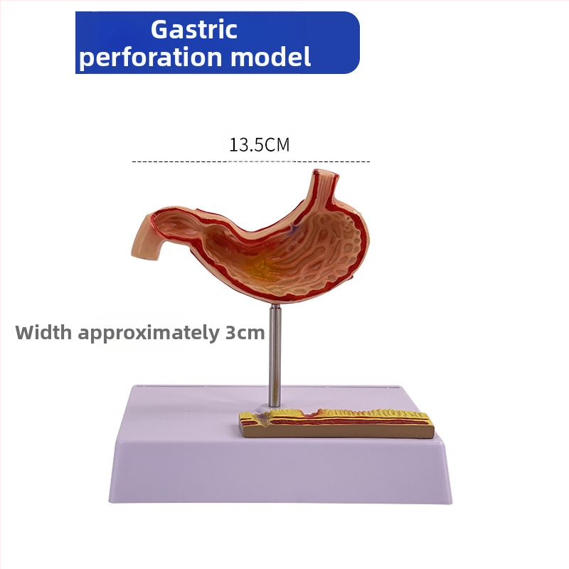 Модел на човешки стомах за анатомия — коронален разрез, патологичен модел със перфорация, обучение по гастроентерология