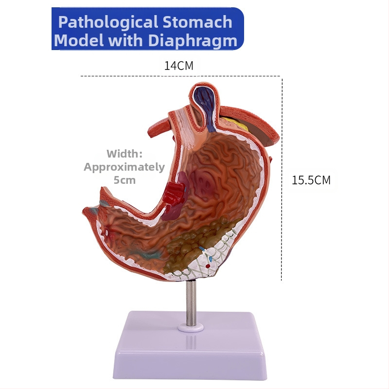 Модел на човешки стомах за анатомия — коронален разрез, патологичен модел със перфорация, обучение по гастроентерология