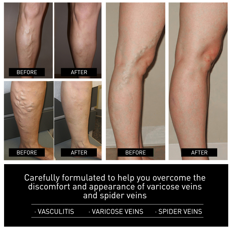 South Moon Ice Silk kvėpuojančios batų įdėklos sąnarių skausmų palengvinti, patinimo mažinimui ir kojų venų masažai — kodas SOA06-A082-1-BK1, ruduo