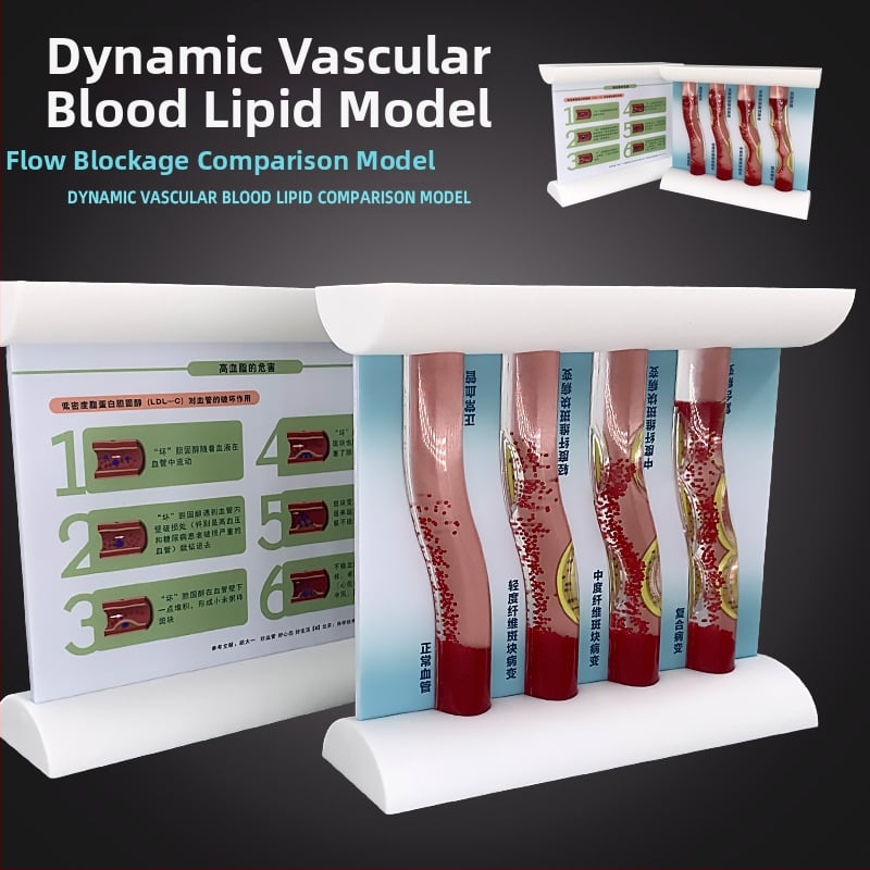Dinaminis kraujagyslių modelis iš plastiko su didelio tankio užsikimšimu ir plokštelių trombu – mokymo modelis