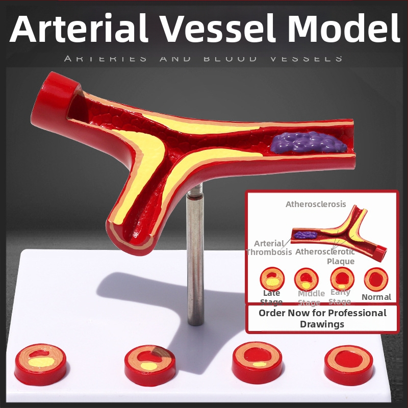 Dinaminis kraujagyslių modelis iš plastiko su didelio tankio užsikimšimu ir plokštelių trombu – mokymo modelis