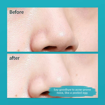 Mary'an dvojhlavý set ihiel na akné pre čistenie pórov a extrakciu čiernych bodiek — 5-ročná životnosť