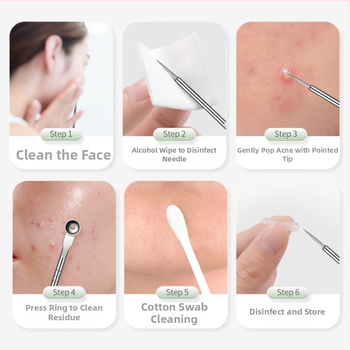 Nerūdijančio plieno aknės adatų rinkinys, 5 dalių, atnaujintas, tikslus juodųjų spuogų ir porų ekstraktorius