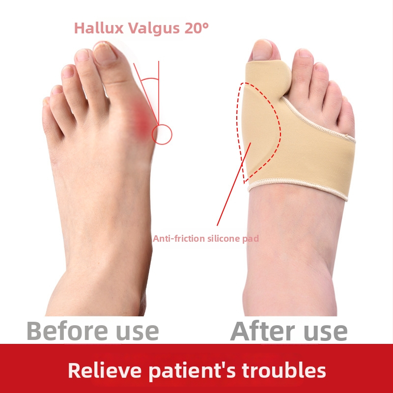 CY-161 nykščio korektoriaus ortozė, kvėpavimo medžiagos TPE, Lycra ir aukštos elastingumo šilkas, ortotinis stilius, tinka visoms sezonoms