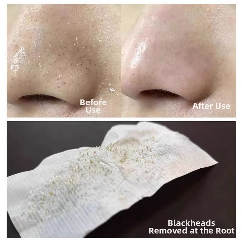 Set pentru îndepărtarea punctelor negre cu Tea Tree – Curățare profundă a porilor, Strângerea porilor, plasturi nazali