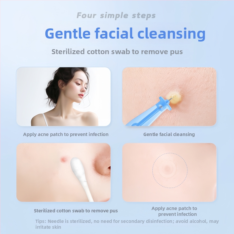 Ühekordne roostevabast teras akne nõel, mõeldud komedoonide ja mustade laikude jaoks (väga peen)