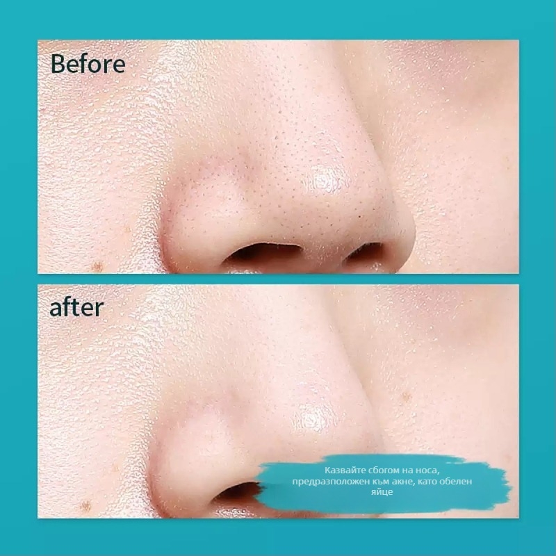 Mary'an Двуглавен комплект игли за акне за почистване на порите и извличане на черни точки — 5-годишен срок на годност