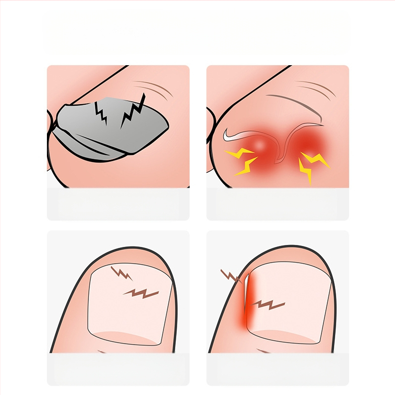 Naujos nagų kirpimo mašinėlės, nagų grioveliai, specialios nagų žirklės, įstrižos burnos prailginimas, vienos vanago žnyplės, įaugusio nago uždegimas, pedikiūro nagų kirpimo mašinėlės