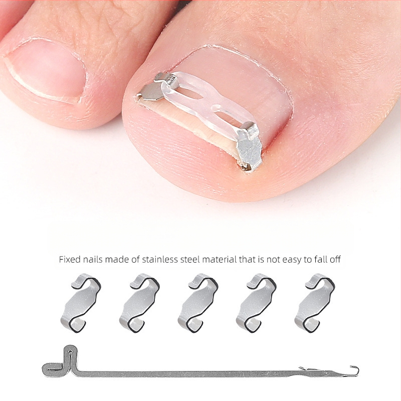 Ortopedinis įtaisas įaugusių nagų korekcijai su tempimo pleistru