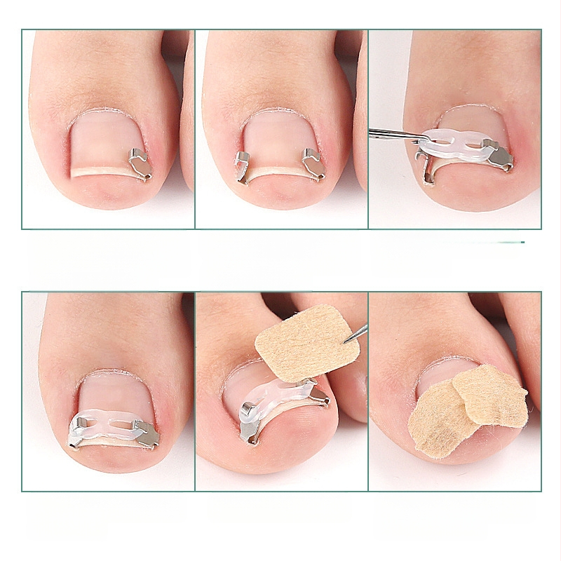 Ortopedinis įtaisas įaugusių nagų korekcijai su tempimo pleistru