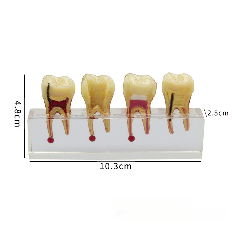 Model educațional stomatologic pentru dinți temporari pediatric cu carie și tratamentul pulpei, GC OEM, 108 g, cod de bare 236, Importat: Nu