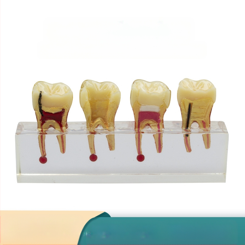 Model educațional stomatologic pentru dinți temporari pediatric cu carie și tratamentul pulpei, GC OEM, 108 g, cod de bare 236, Importat: Nu