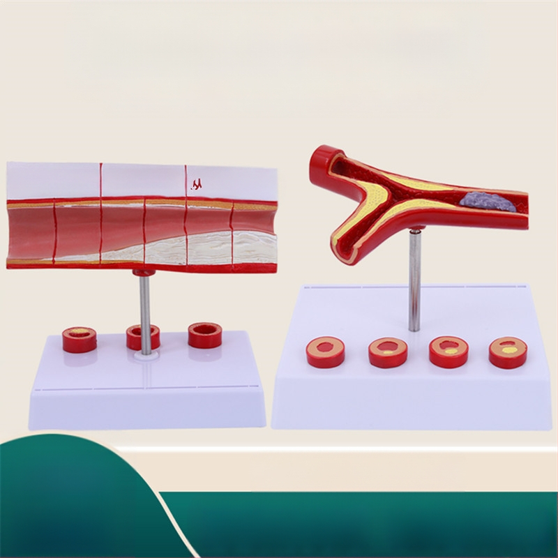 Μοντέλο Παθολογίας Αιμοφόρων Αγγείων για Θρόμβωση, Αθηροσκλήρωση και Υπερτροφία Αρτηριών