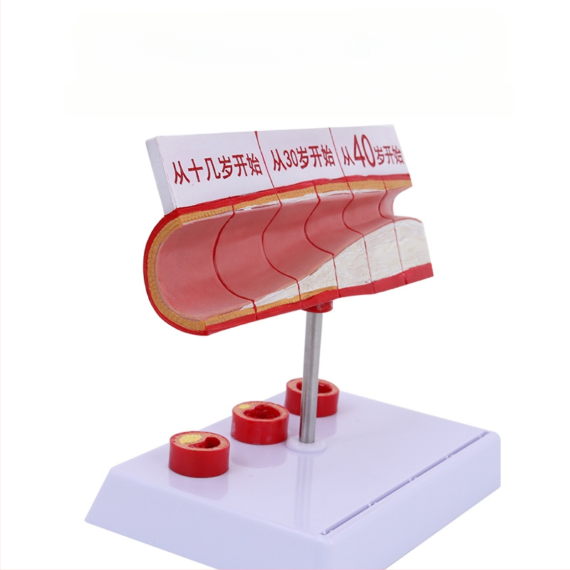 Μοντέλο Παθολογίας Αιμοφόρων Αγγείων για Θρόμβωση, Αθηροσκλήρωση και Υπερτροφία Αρτηριών