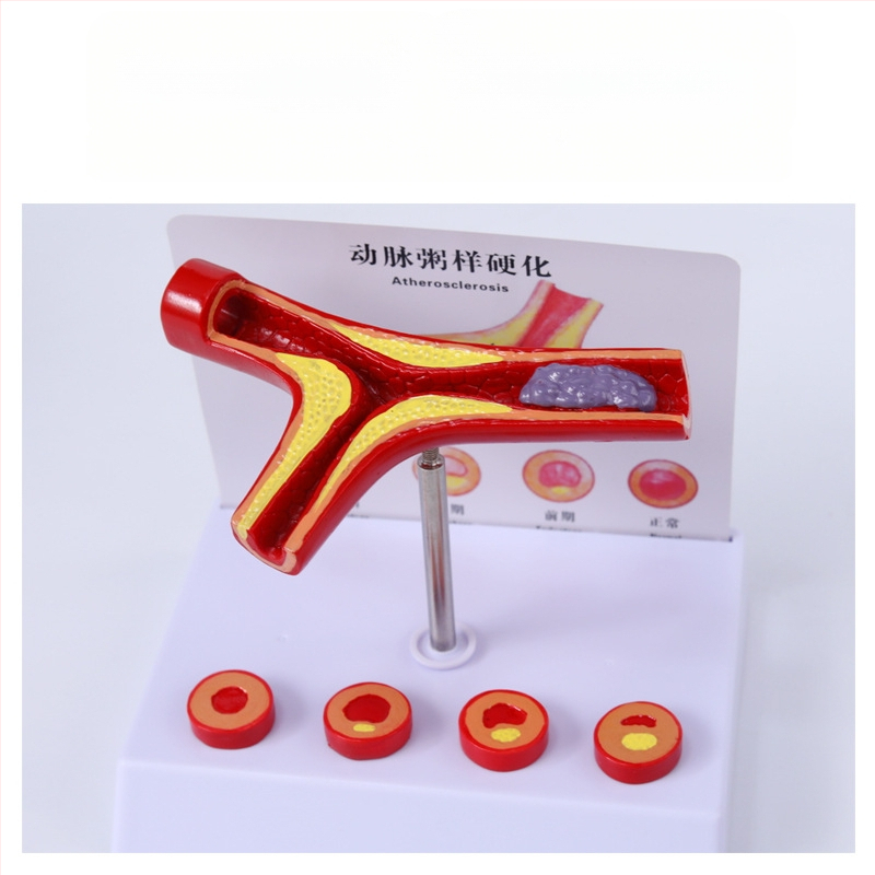 Μοντέλο Παθολογίας Αιμοφόρων Αγγείων για Θρόμβωση, Αθηροσκλήρωση και Υπερτροφία Αρτηριών