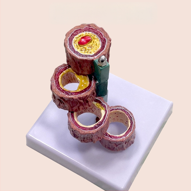 Μοντέλο Παθολογίας Αιμοφόρων Αγγείων για Θρόμβωση, Αθηροσκλήρωση και Υπερτροφία Αρτηριών