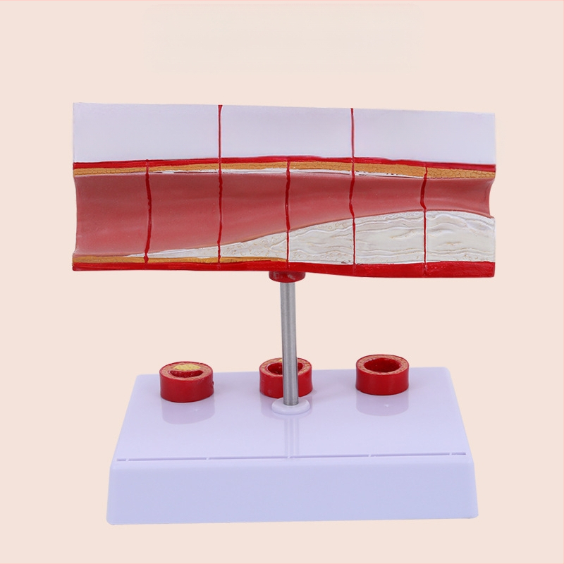 Μοντέλο Παθολογίας Αιμοφόρων Αγγείων για Θρόμβωση, Αθηροσκλήρωση και Υπερτροφία Αρτηριών