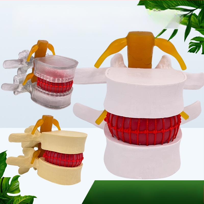 Лумбален модел за медицинско обучение – демонстрация на компресия на лумбалния диск и патология на костите на гръбначния стълб.