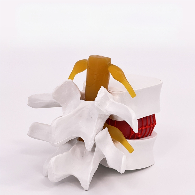 Лумбален модел за медицинско обучение – демонстрация на компресия на лумбалния диск и патология на костите на гръбначния стълб.