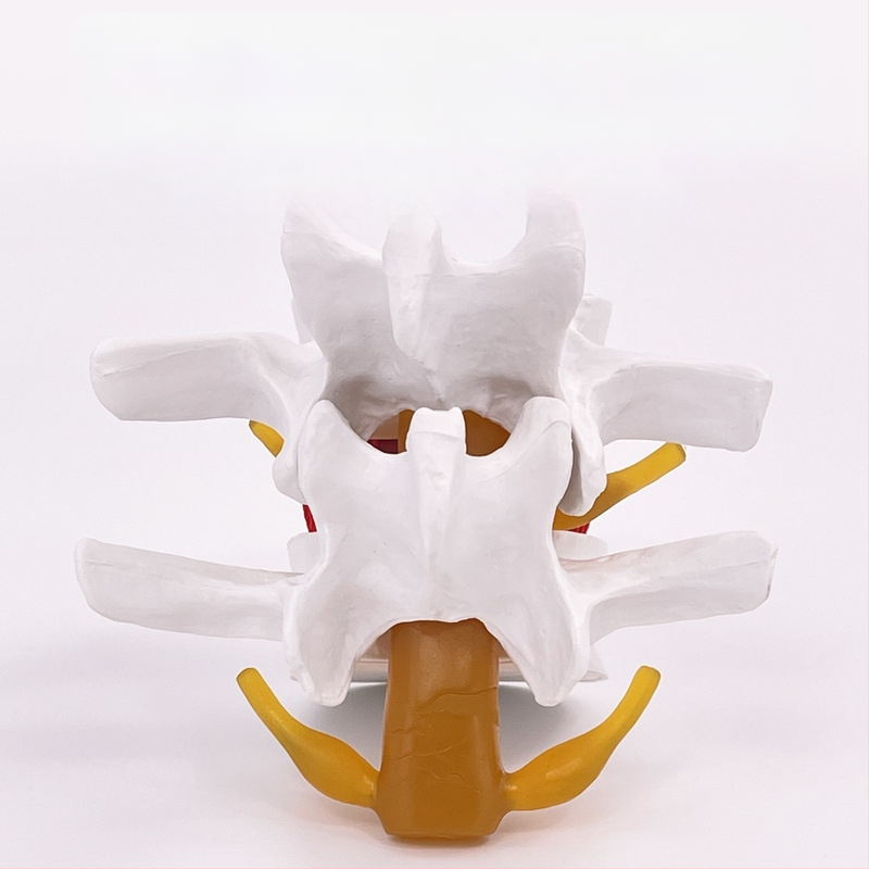 Лумбален модел за медицинско обучение – демонстрация на компресия на лумбалния диск и патология на костите на гръбначния стълб.