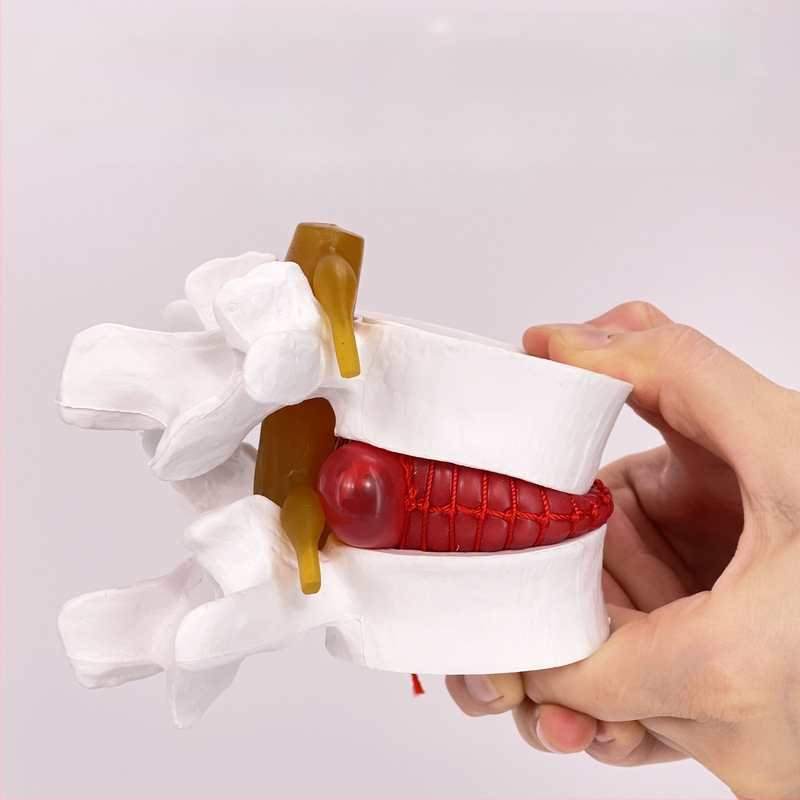 Лумбален модел за медицинско обучение – демонстрация на компресия на лумбалния диск и патология на костите на гръбначния стълб.