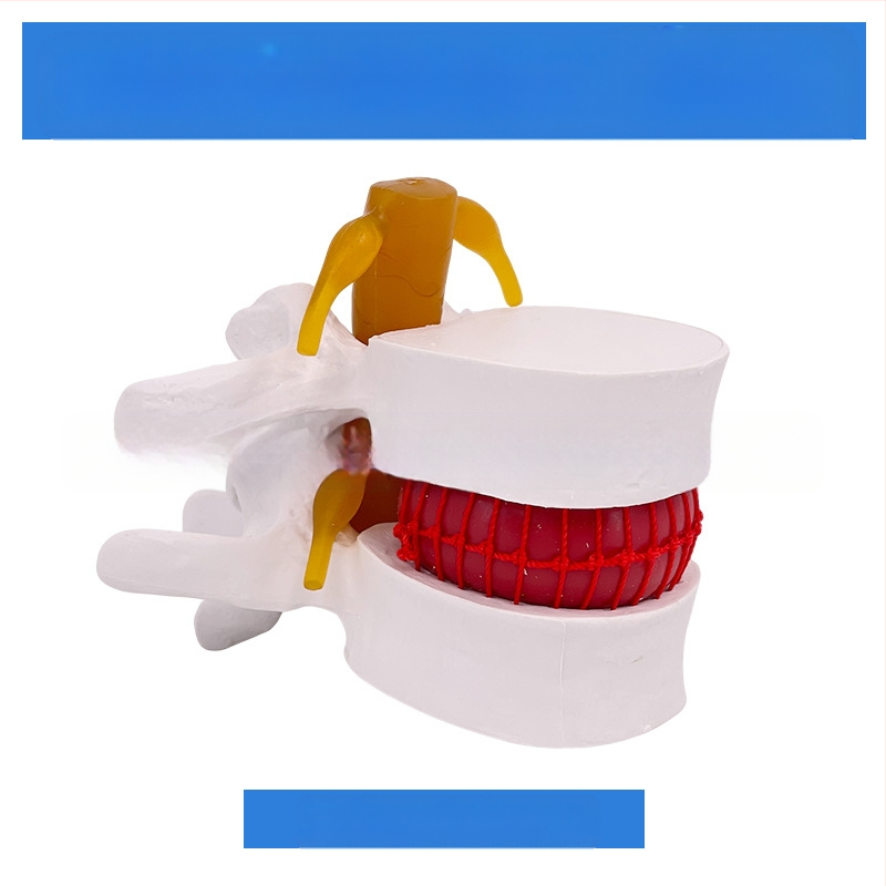 Лумбален модел за медицинско обучение – демонстрация на компресия на лумбалния диск и патология на костите на гръбначния стълб.