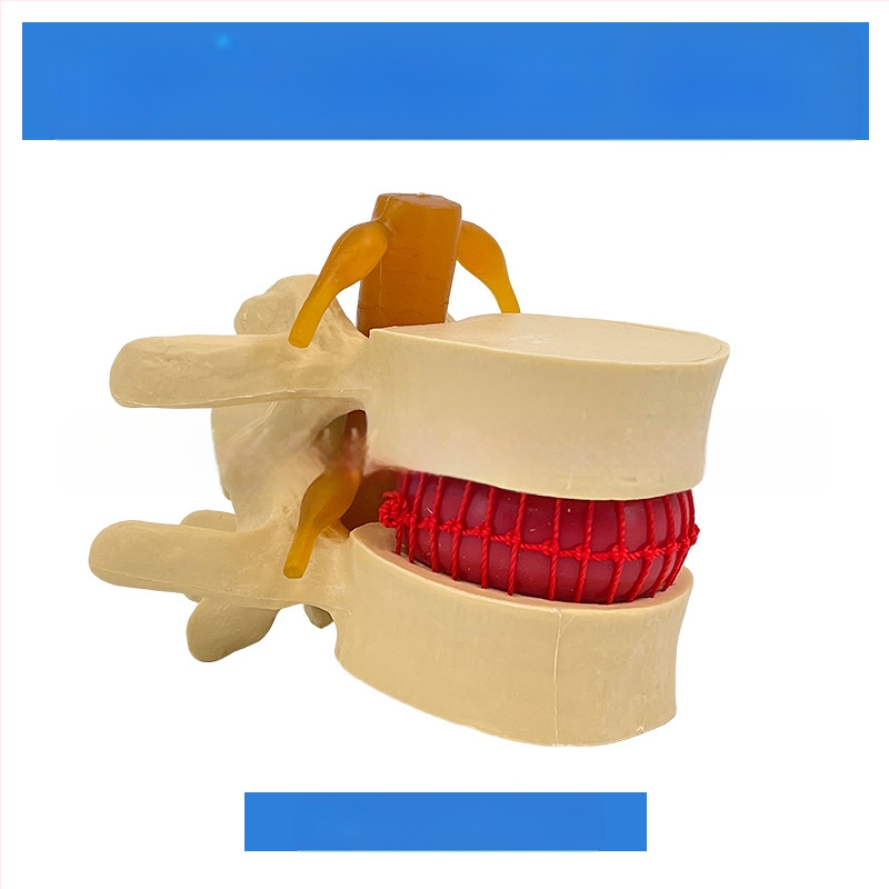 Лумбален модел за медицинско обучение – демонстрация на компресия на лумбалния диск и патология на костите на гръбначния стълб.