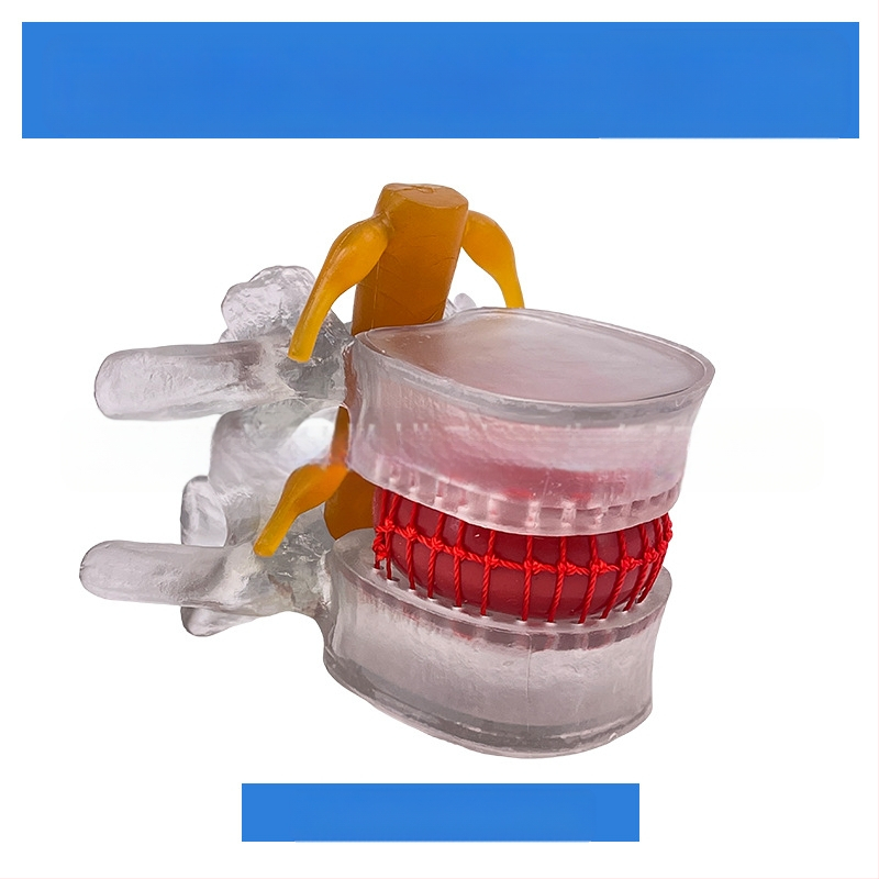 Лумбален модел за медицинско обучение – демонстрация на компресия на лумбалния диск и патология на костите на гръбначния стълб.