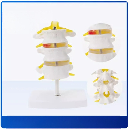 Модел на междупрешленния диск, PVC учебен анатомичен модел за демонстрация на патология на лумбалния гръбнак, Zhenghe River