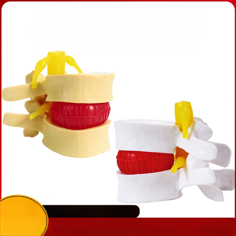 Модел на междупрешленния диск, PVC учебен анатомичен модел за демонстрация на патология на лумбалния гръбнак, Zhenghe River