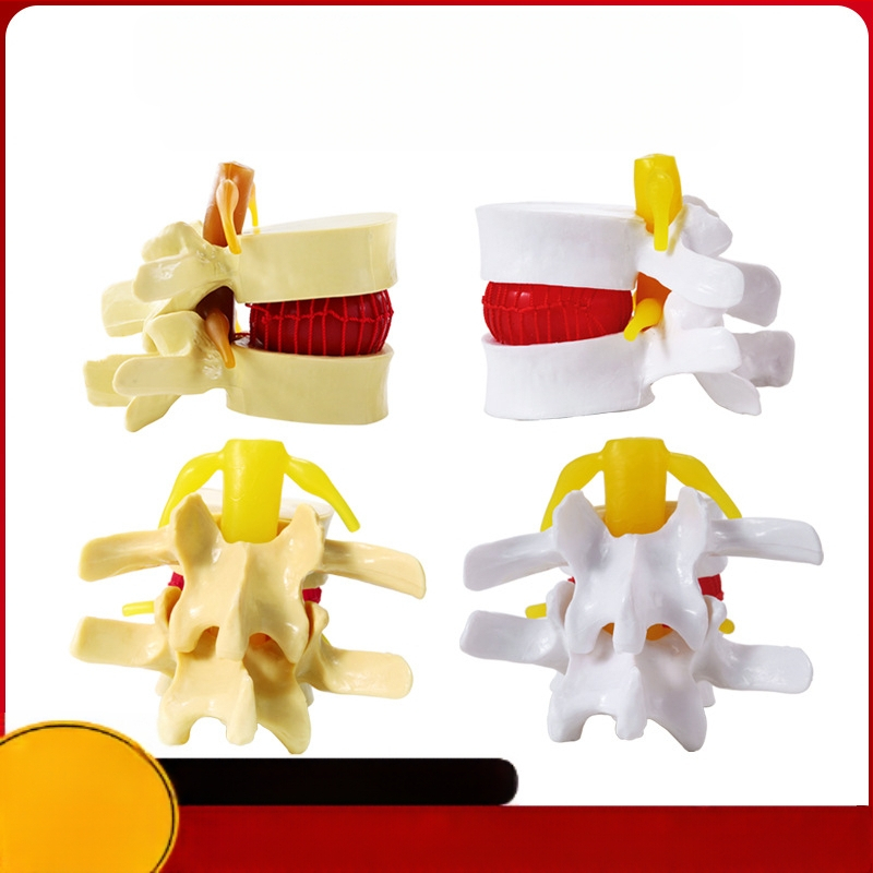 Модел на междупрешленния диск, PVC учебен анатомичен модел за демонстрация на патология на лумбалния гръбнак, Zhenghe River