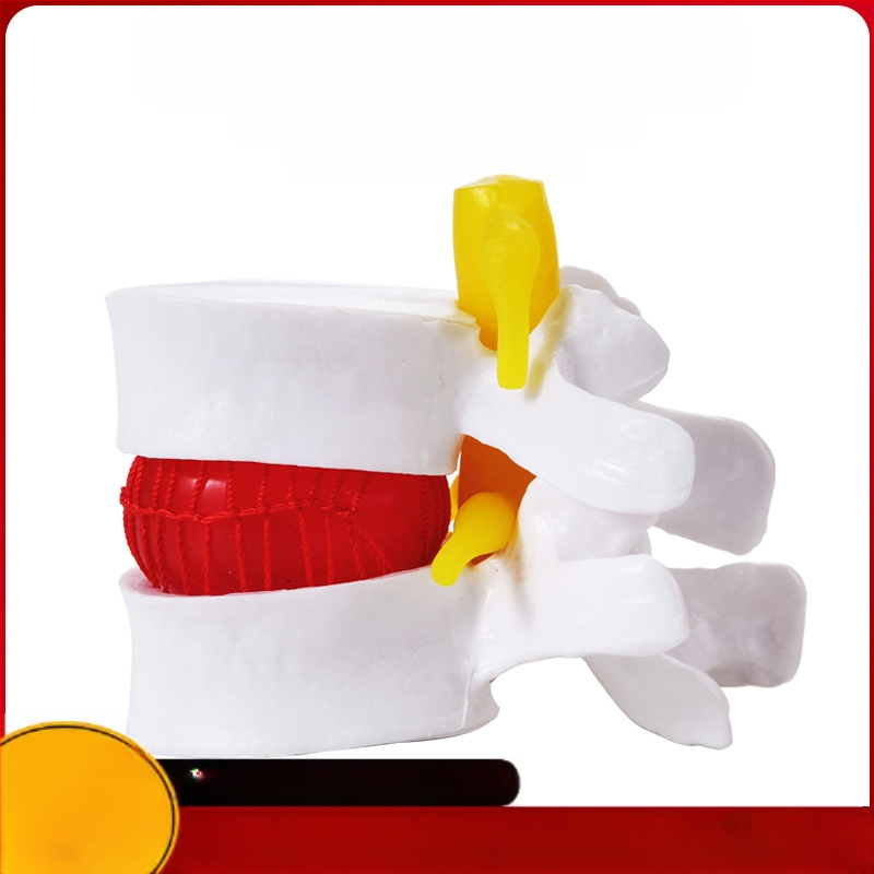 Модел на междупрешленния диск, PVC учебен анатомичен модел за демонстрация на патология на лумбалния гръбнак, Zhenghe River