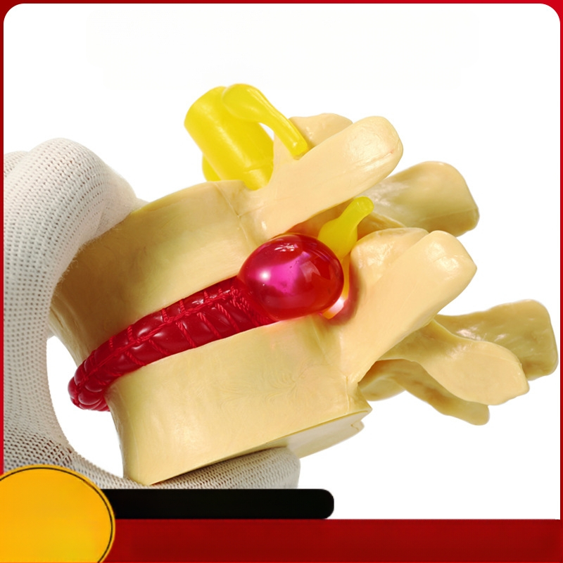 Модел на междупрешленния диск, PVC учебен анатомичен модел за демонстрация на патология на лумбалния гръбнак, Zhenghe River