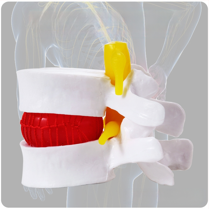 Модел на междупрешленния диск, PVC учебен анатомичен модел за демонстрация на патология на лумбалния гръбнак, Zhenghe River