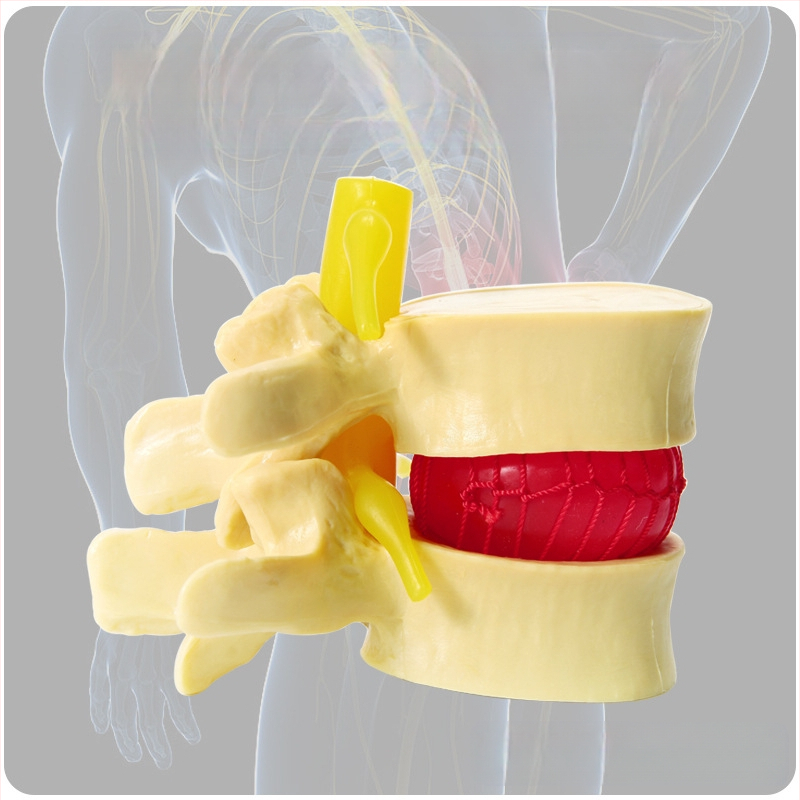 Модел на междупрешленния диск, PVC учебен анатомичен модел за демонстрация на патология на лумбалния гръбнак, Zhenghe River