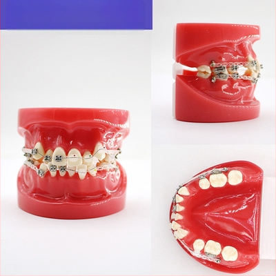 Μοντέλο διδασκαλίας οδοντιατρικής με παθολογική αποκατάσταση και τυπικό καλούπι εμφυτευμάτων — εγχώριο εμπορικό σήμα, με εκτυπωμένο λογότυπο, κατάλληλο για την οδοντιατρική εκπαίδευση