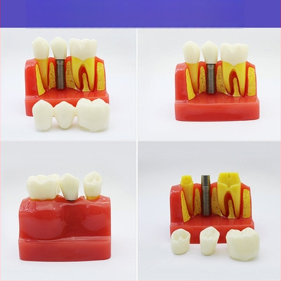 Μοντέλο διδασκαλίας οδοντιατρικής με παθολογική αποκατάσταση και τυπικό καλούπι εμφυτευμάτων — εγχώριο εμπορικό σήμα, με εκτυπωμένο λογότυπο, κατάλληλο για την οδοντιατρική εκπαίδευση