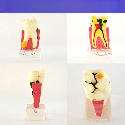 Μοντέλο διδασκαλίας οδοντιατρικής με παθολογική αποκατάσταση και τυπικό καλούπι εμφυτευμάτων — εγχώριο εμπορικό σήμα, με εκτυπωμένο λογότυπο, κατάλληλο για την οδοντιατρική εκπαίδευση