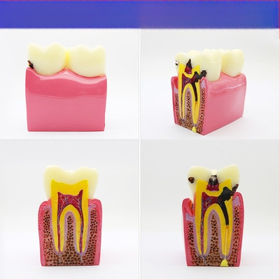 Μοντέλο διδασκαλίας οδοντιατρικής με παθολογική αποκατάσταση και τυπικό καλούπι εμφυτευμάτων — εγχώριο εμπορικό σήμα, με εκτυπωμένο λογότυπο, κατάλληλο για την οδοντιατρική εκπαίδευση