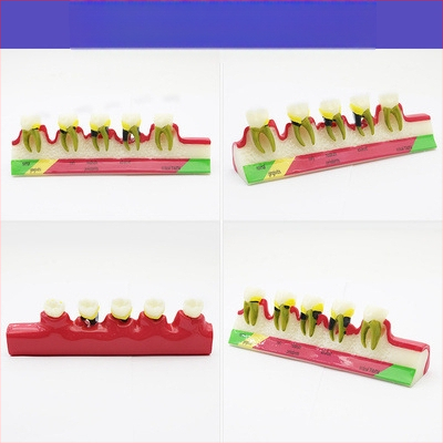 Μοντέλο διδασκαλίας οδοντιατρικής με παθολογική αποκατάσταση και τυπικό καλούπι εμφυτευμάτων — εγχώριο εμπορικό σήμα, με εκτυπωμένο λογότυπο, κατάλληλο για την οδοντιατρική εκπαίδευση