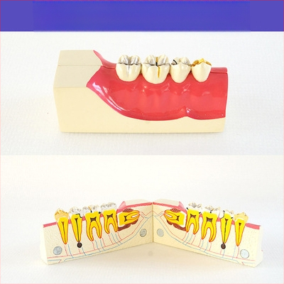 Μοντέλο διδασκαλίας οδοντιατρικής με παθολογική αποκατάσταση και τυπικό καλούπι εμφυτευμάτων — εγχώριο εμπορικό σήμα, με εκτυπωμένο λογότυπο, κατάλληλο για την οδοντιατρική εκπαίδευση