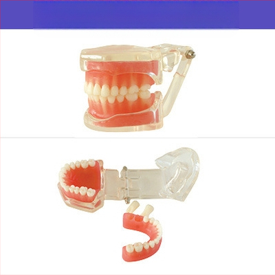 Μοντέλο διδασκαλίας οδοντιατρικής με παθολογική αποκατάσταση και τυπικό καλούπι εμφυτευμάτων — εγχώριο εμπορικό σήμα, με εκτυπωμένο λογότυπο, κατάλληλο για την οδοντιατρική εκπαίδευση