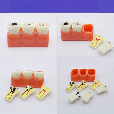 Μοντέλο διδασκαλίας οδοντιατρικής με παθολογική αποκατάσταση και τυπικό καλούπι εμφυτευμάτων — εγχώριο εμπορικό σήμα, με εκτυπωμένο λογότυπο, κατάλληλο για την οδοντιατρική εκπαίδευση