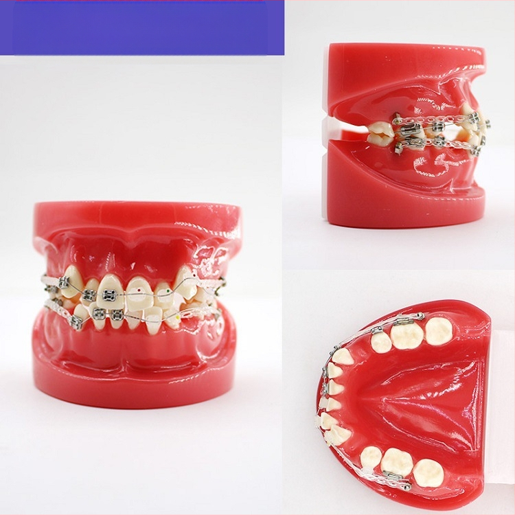 Μοντέλο διδασκαλίας οδοντιατρικής με παθολογική αποκατάσταση και τυπικό καλούπι εμφυτευμάτων — εγχώριο εμπορικό σήμα, με εκτυπωμένο λογότυπο, κατάλληλο για την οδοντιατρική εκπαίδευση