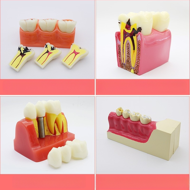 Μοντέλο διδασκαλίας οδοντιατρικής με παθολογική αποκατάσταση και τυπικό καλούπι εμφυτευμάτων — εγχώριο εμπορικό σήμα, με εκτυπωμένο λογότυπο, κατάλληλο για την οδοντιατρική εκπαίδευση