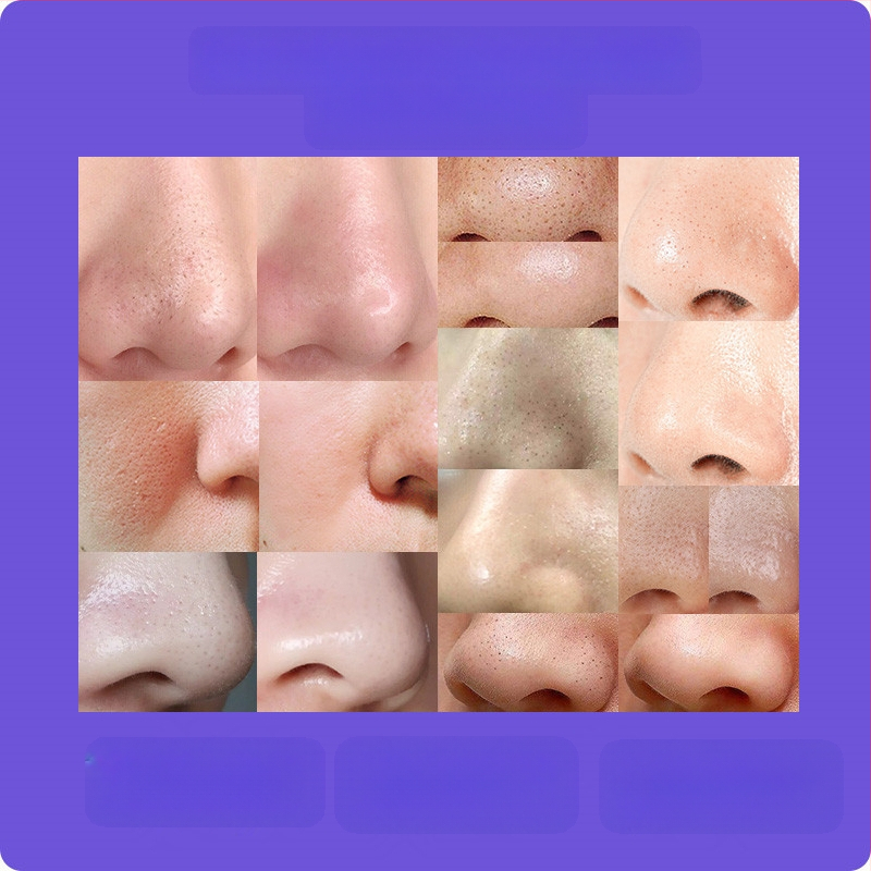 Визуално премахване на черни точки — ултразвуков ръчен уред, модел ZM613, ABS корпус, 3 степени на настройка