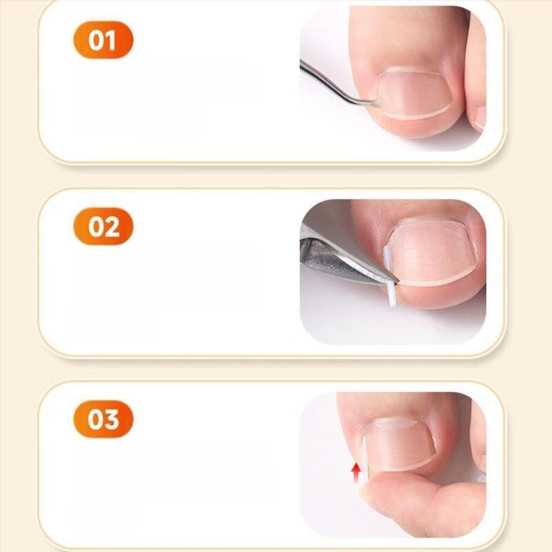 Μίνι πλαστικό υπόθεμα διόρθωσης για το νύχι του μεγάλου δακτύλου, φορητό και σκίζεται