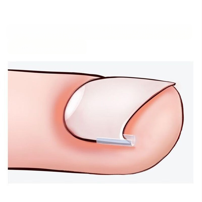 Μίνι πλαστικό υπόθεμα διόρθωσης για το νύχι του μεγάλου δακτύλου, φορητό και σκίζεται