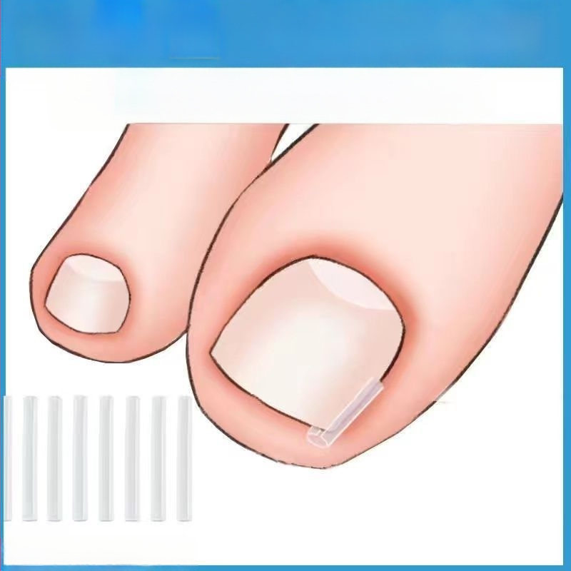 Μίνι πλαστικό υπόθεμα διόρθωσης για το νύχι του μεγάλου δακτύλου, φορητό και σκίζεται