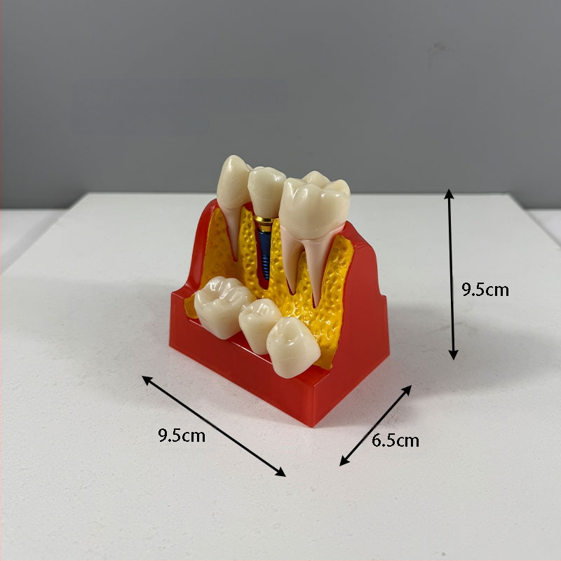 Dantų mokymo modelis studentų praktikai su implantavimo smeigių demonstravimu, dervos medžiaga, prekinis ženklas Liyue; palaiko privačias prekes